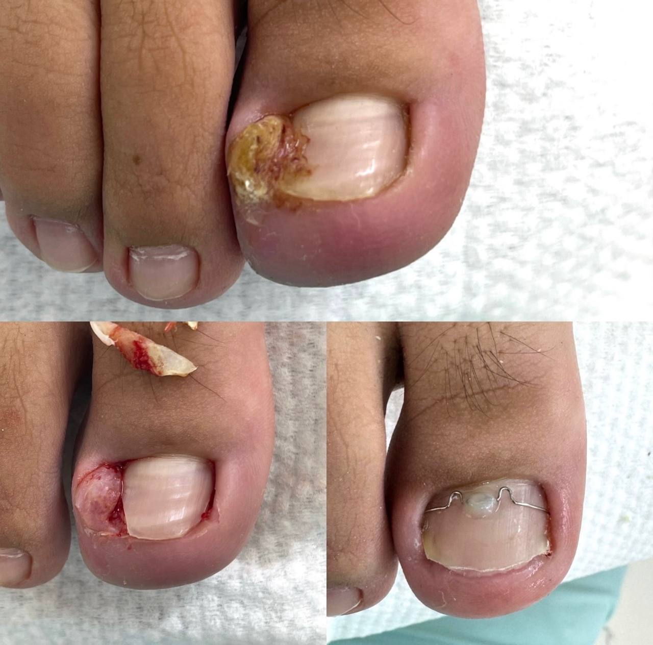Реальный кейс PodoNails по вросшему ногтю